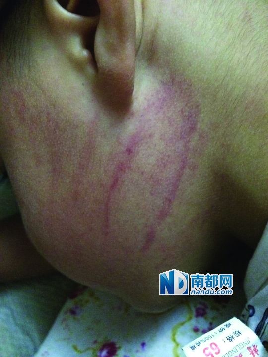 小逸臉上淤痕清晰可見。