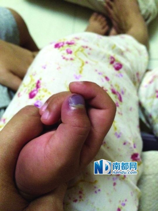 小逸手指被夾傷。