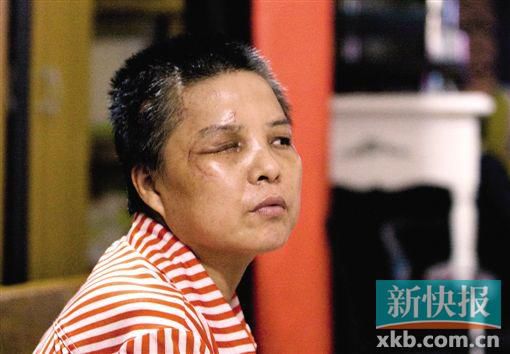 4月初,趙女士遭人搶劫并被打傷,現(xiàn)今右眼失明,頭部被縫100多針。記者 畢志毅/攝