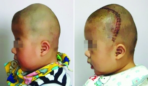 術(shù)前（左），術(shù)后（右）