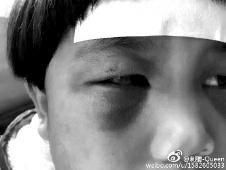 6月2日，網(wǎng)曝渭南市臨渭區(qū)一不滿5歲的女童遭奶奶毆打，眼圈青腫，引起網(wǎng)友關(guān)注，但孩子父母和爺爺均稱是摔倒導(dǎo)致。相關(guān)部門介入調(diào)查發(fā)現(xiàn)確為奶奶毆打所致，鑒于其身體原因已進行批評教育。