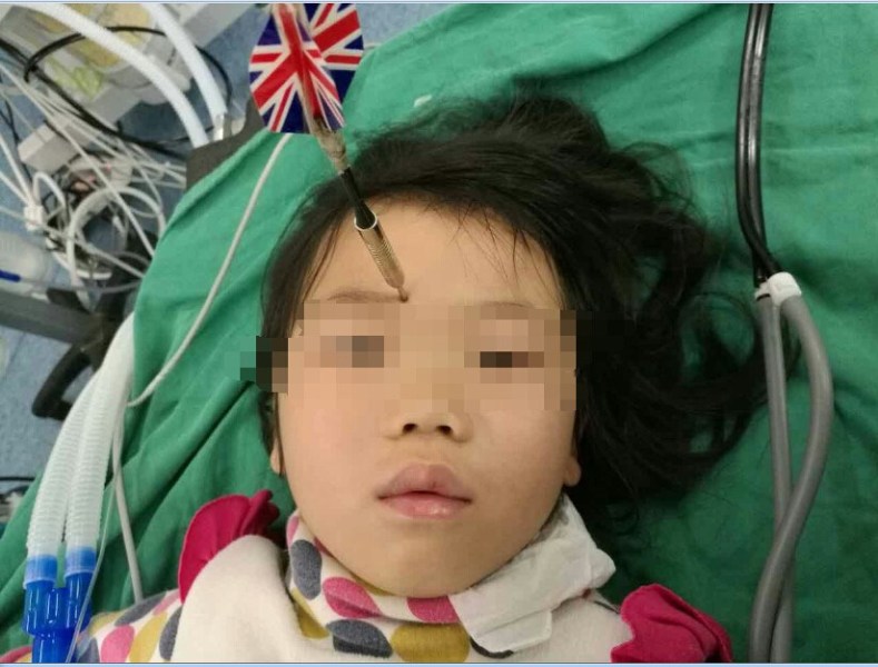 十多公分長的飛鏢穩(wěn)穩(wěn)地 ” 定 ” 在了一名六歲半的女童額頭上，小青一家人凌晨從長順趕到貴醫(yī)附院急診室時，看到如此慘烈的情況，接診醫(yī)生都嚇了一跳。詳細詢問下得知，原來是七歲的哥哥和六歲半的表妹在玩耍時，哥哥不慎將路邊撿來的真飛鏢扎到了妹妹的額頭上。