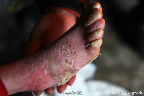 男孩皮膚一碰就破 裹衛(wèi)生紙堅(jiān)持上學(xué) 男孩皮膚一碰就破 裹衛(wèi)生紙堅(jiān)持上學(xué)