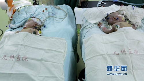 一對(duì)連體女嬰成功分離 一對(duì)連體女嬰成功分離