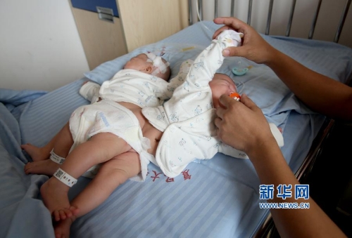 一對(duì)連體女嬰成功分離 一對(duì)連體女嬰成功分離