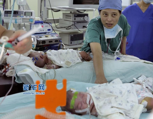 一對(duì)連體女嬰成功分離 一對(duì)連體女嬰成功分離