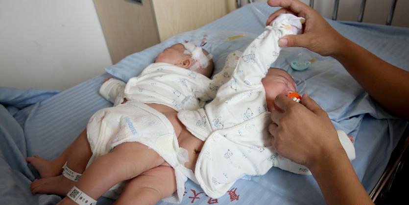 一對(duì)連體女嬰成功分離 一對(duì)連體女嬰成功分離