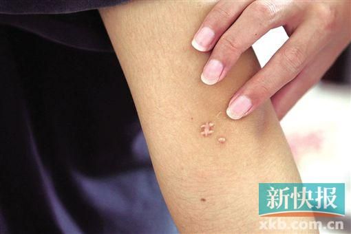 取出針后李星兒手臂留下了傷口。新快報(bào)記者 張國鋒/攝