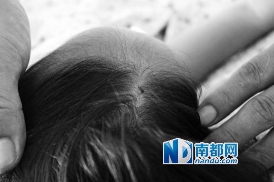 女童頭上被扎的針孔（圓圈處）。賈先生說，被扎不到三秒鐘，女兒就昏了。