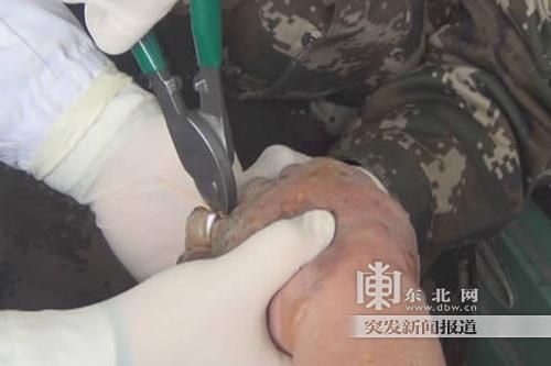 正在拆除戒指。