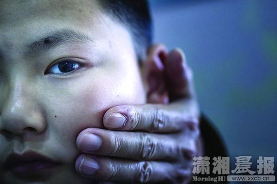1月13日，小玨的父親心疼地摸著兒子的臉。